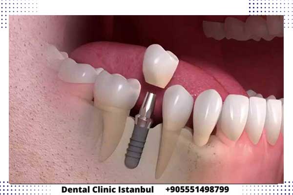 أسعار تركيب جسور الأسنان في تركيا: دليل شامل وأحدث الأسعار