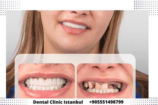 Precios de reparación dental en Turquía
