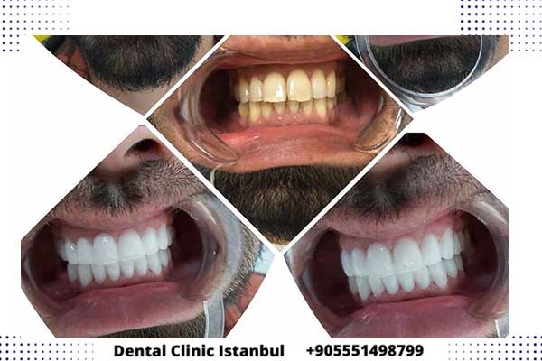 أنواع ابتسامة هوليود في تركيا - عروض أسعار هوليود سمايل اسطنبول