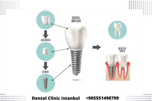 ثمن زراعة الاسنان في تركيا