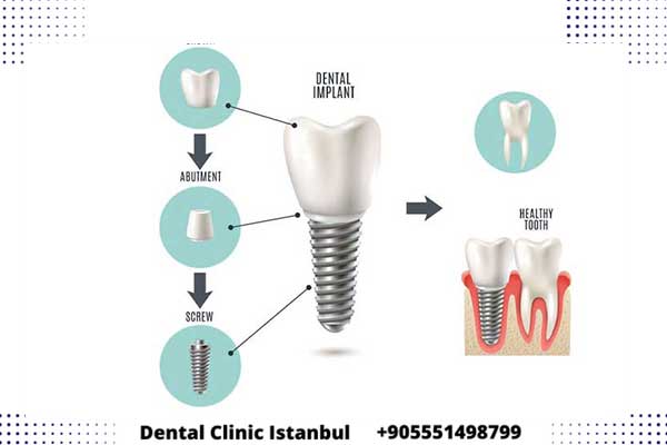 ثمن زراعة الأسنان في تركيا 2024: دليل شامل