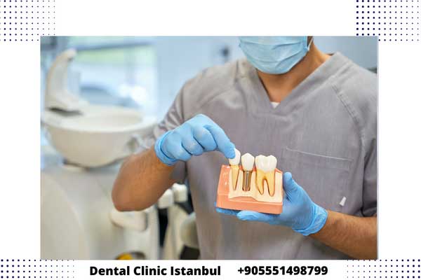 تجربتي مع زراعة الأسنان – نصائح لإختيار أفضل زراعة أسنان في اسطنبول