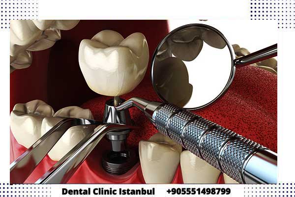 زراعة الأسنان بدون جراحة في تركيا