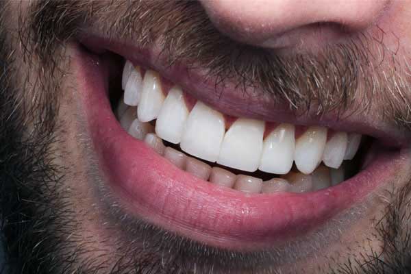 Blanqueamiento Dental en Turquía: Descubre el Secreto de una Sonrisa Perfecta en 2024