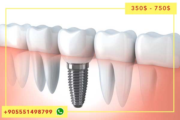 Implantes dentales no quirúrgicos en Turquía