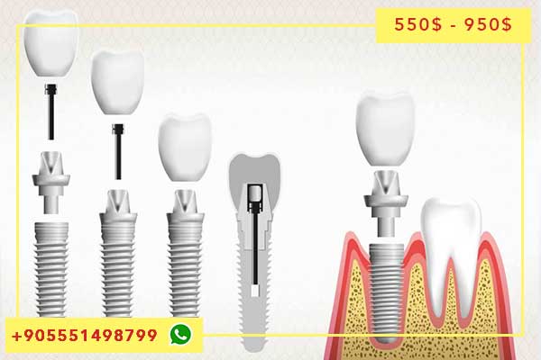 Implantes dentales en Turquía