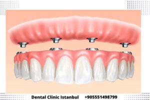 Cuánto valen los implantes dentales