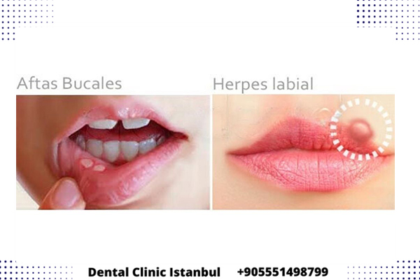 Diferencias entre Herpes Labiales y Aftas Bucales