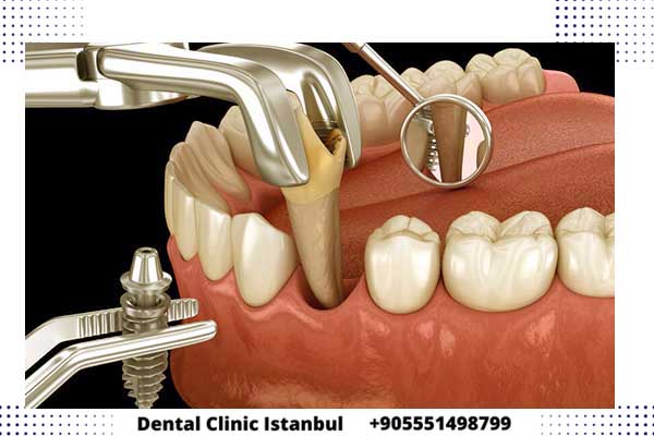 تركيب الاسنان في تركيا