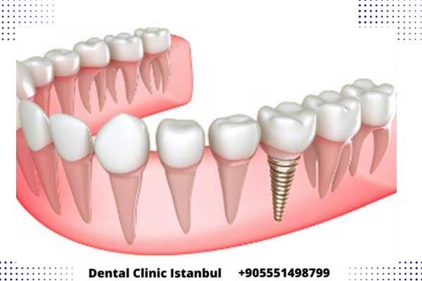 أنواع زراعة الأسنان في تركيا – مميزات زرع الأسنان في تركيا