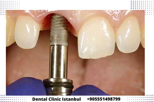 طريقة زراعة الاسنان الفورية في تركيا – المراحل و أهم المعلومات