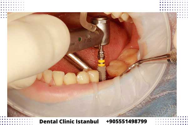 تقنيات علاج الاسنان في تركيا - أفضل علاجات الأسنان الحديثة