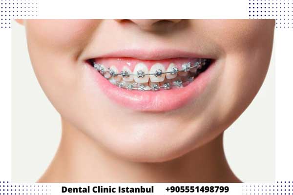 تقويم الاسنان في تركيا اسطنبول – الأنواع ومميزات كل نوع