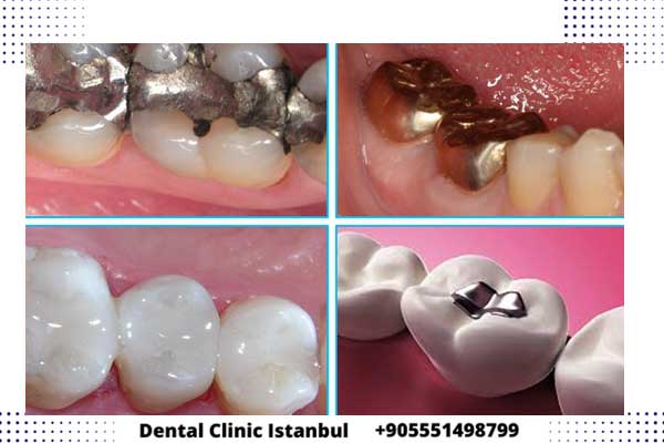 حشو الاسنان في تركيا اسطنبول أفضل الأنواع و الخيارات