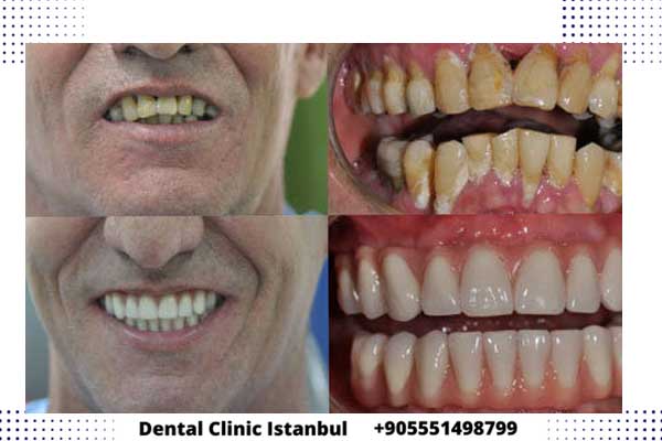 زراعة الاسنان الفورية في اسطنبول تركيا - الأسعار و التفاصيل