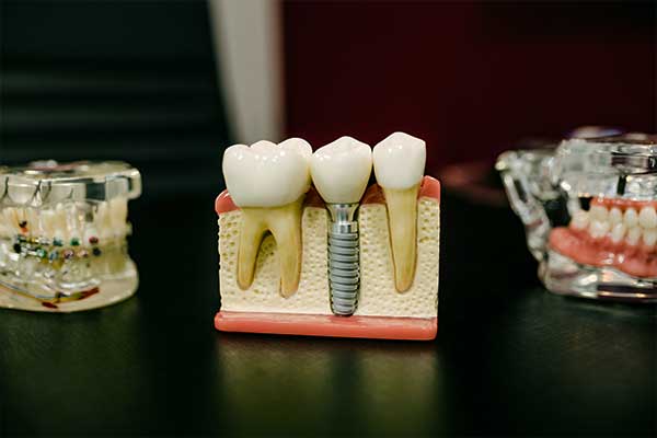 Combien coûtent les implants dentaires en Turquie