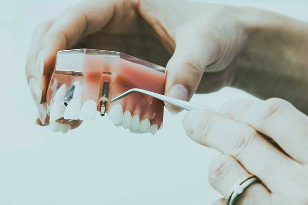 Navigating Airport Security with Dental Implants