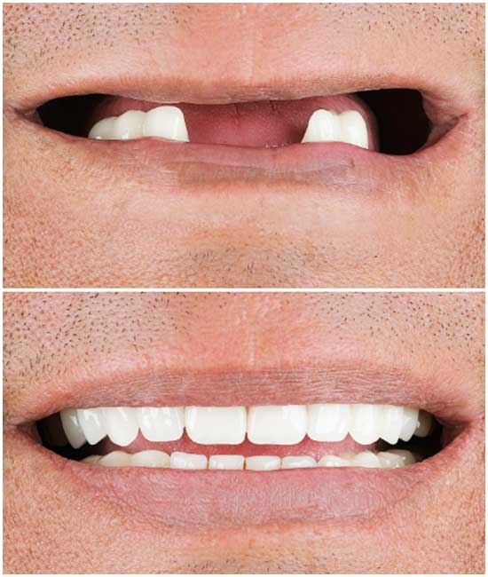 cosmetic denture a1