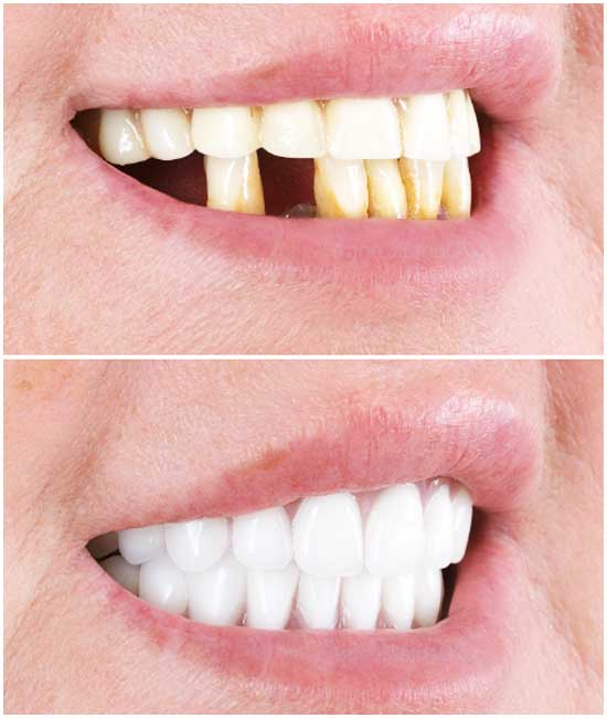 cosmetic dentures , bl2