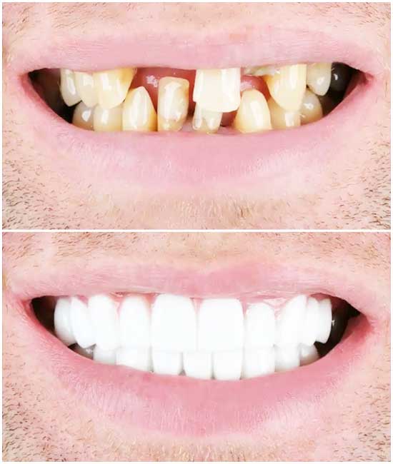 dientes frontales del puente dental, bl2