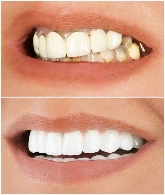 corona dental b1
