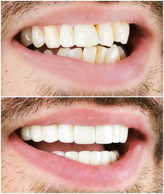 corona dentale bl1
