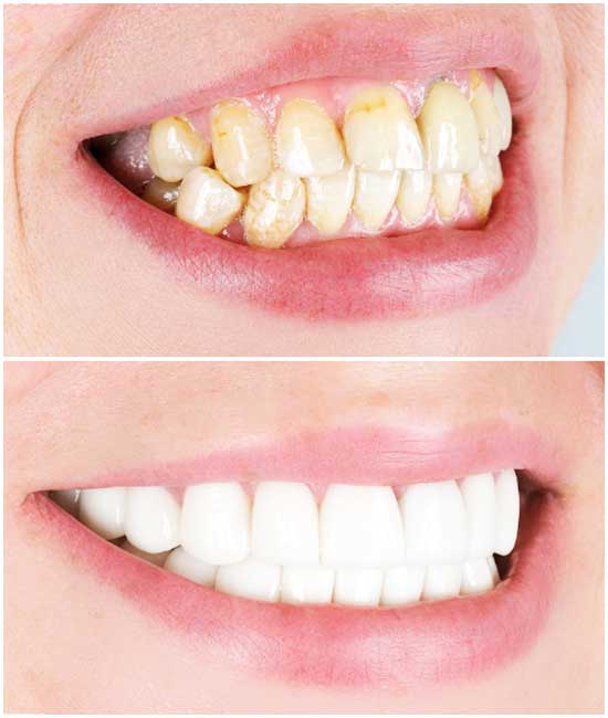 corona dental bl1