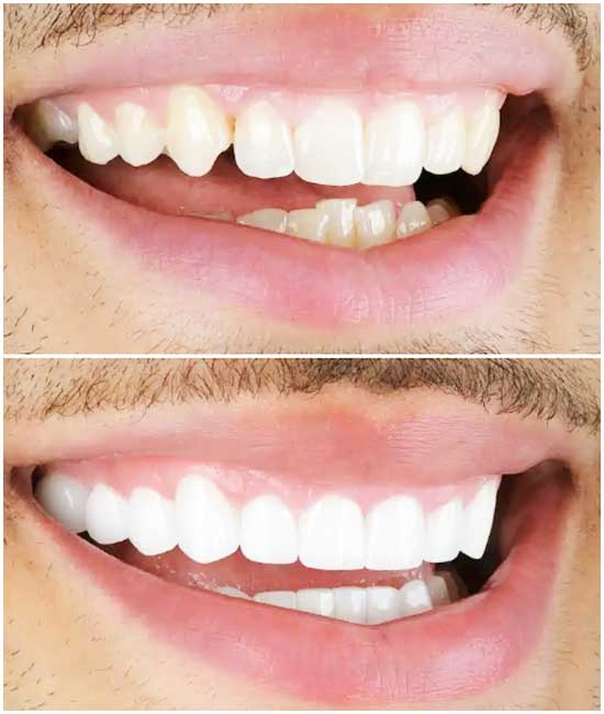 corona dentale bl2