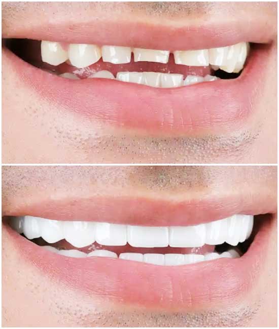 corona dental, bl2