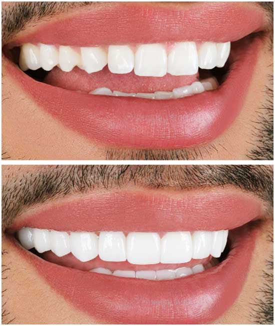 corona dental bl3