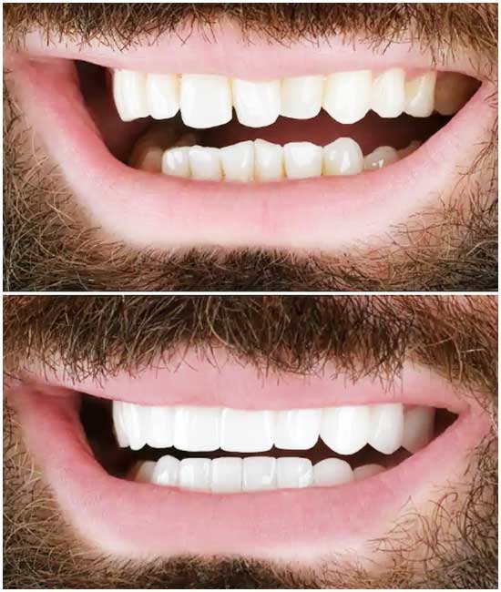 corona dentale bl3