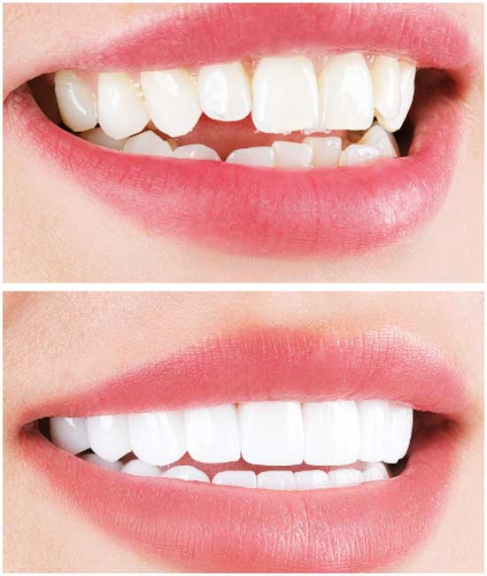 corona dentale dct white®