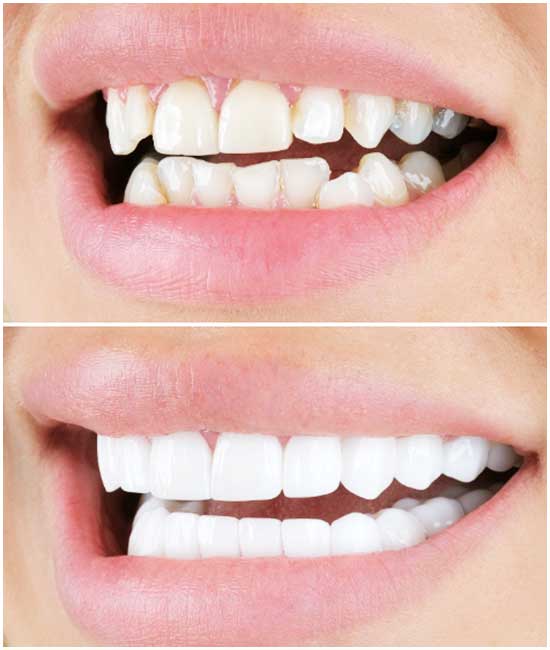 corona dentale dct white®