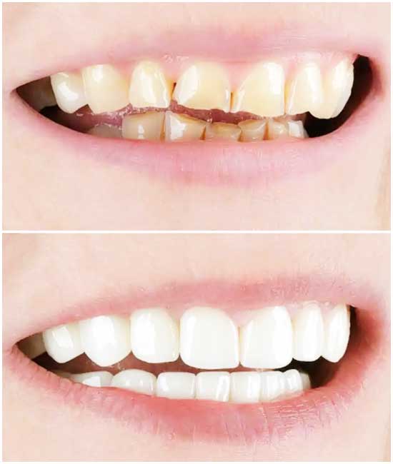 corone dentali b1