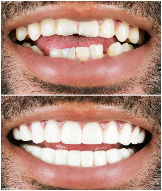 coronas dentales, bl1 55