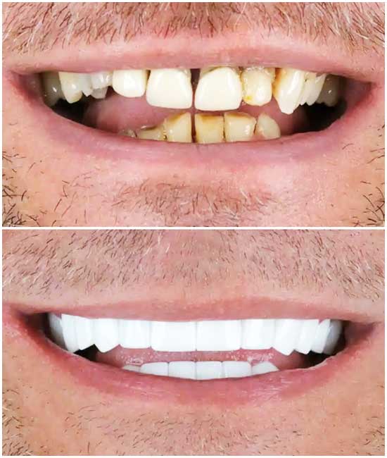 coronas dentales, bl1