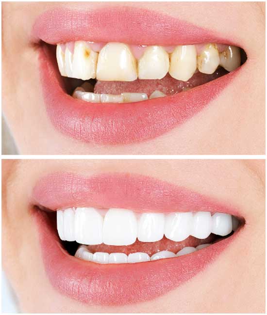 coronas dentales, bl2