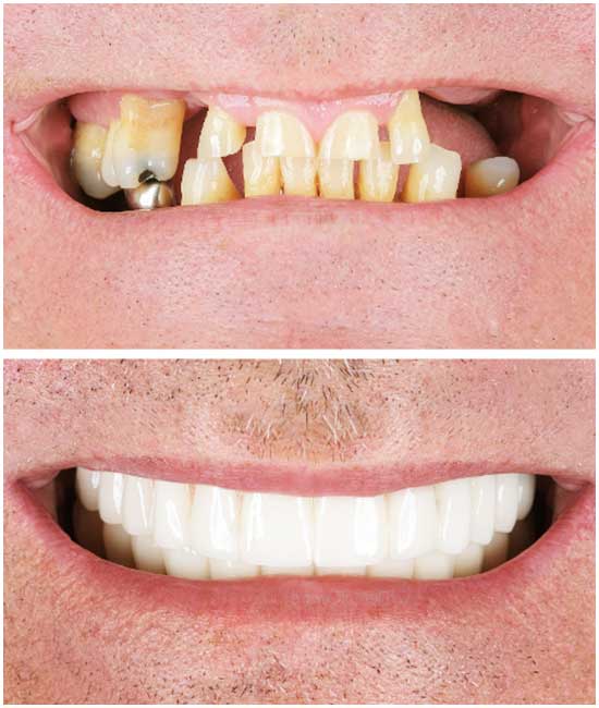 dental implant a1 