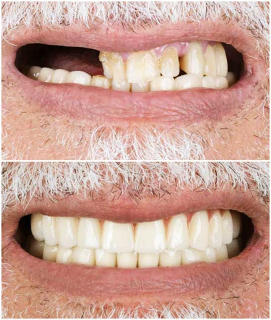 implante dental a1