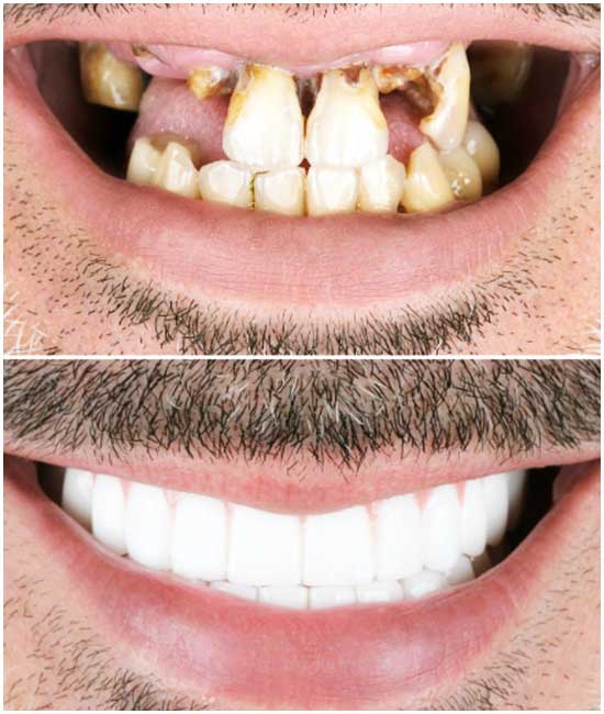 implante dental, a3