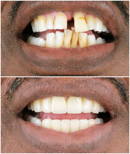 dental implant bl2