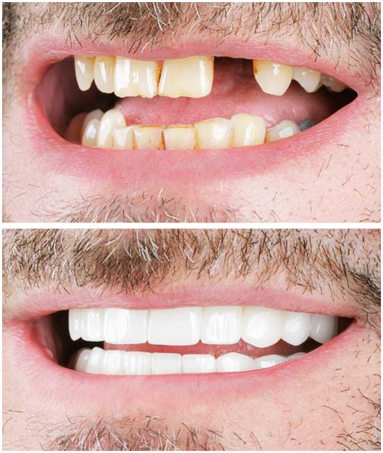 implantes dentales, bl1
