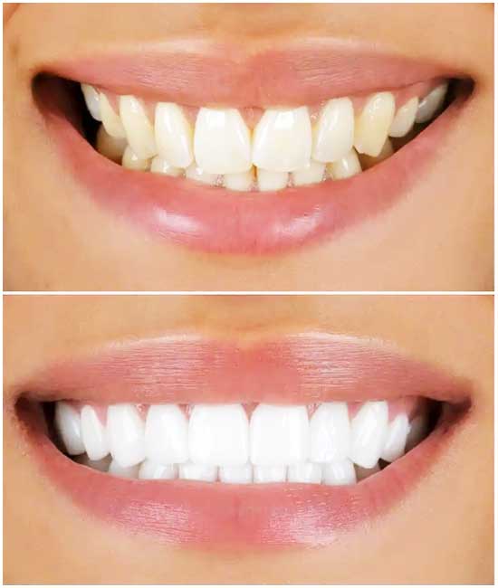 foto prima e dopo odontoiatria turchia