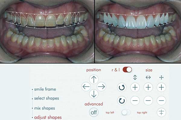 odontoiatria di progettazione del sorriso in Turchia