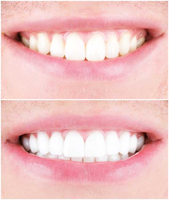 Smile Makeover, DCT weiß