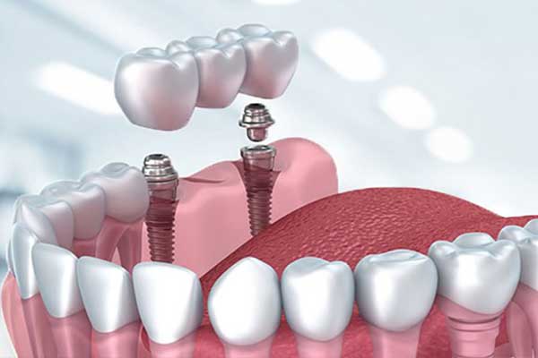 implantes dentales turquía precios