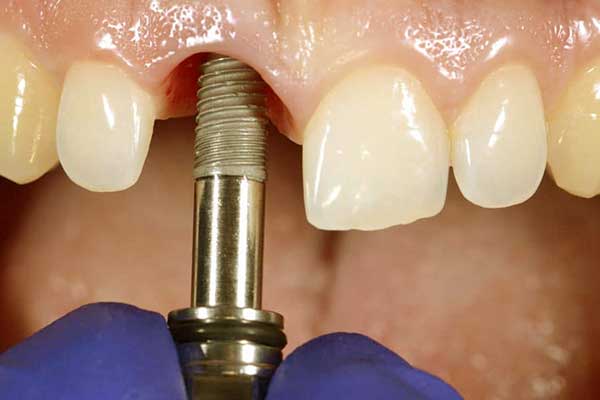 precio implantes dentales en estambul