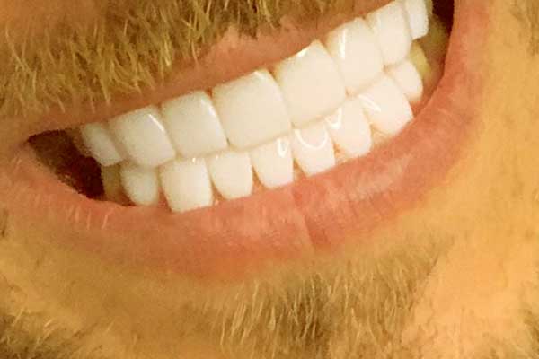 denti in zirconio turchia