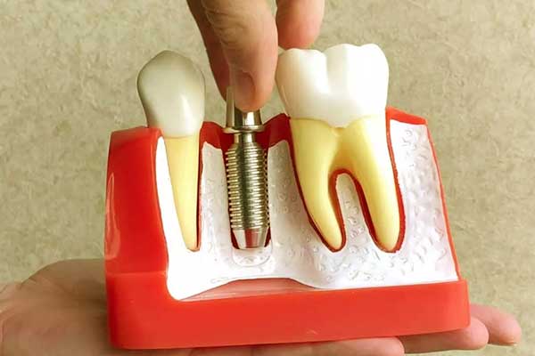 precio implantes dentales para toda boca turquía