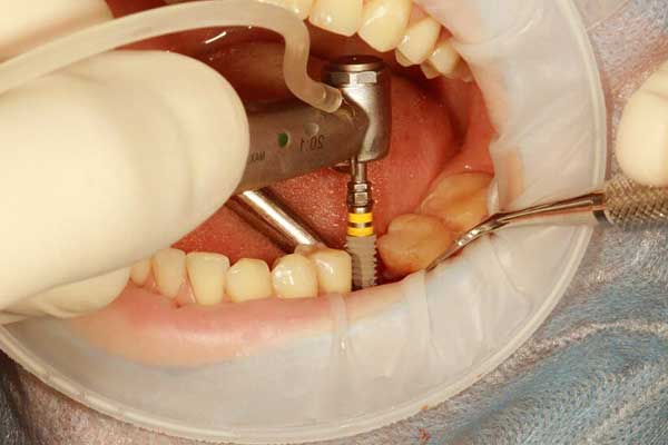precio implantes dentales en turquía